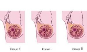 Рак молочной железы Лечение слизистого рака молочной железы